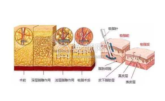 吸脂减肥应注意哪些?