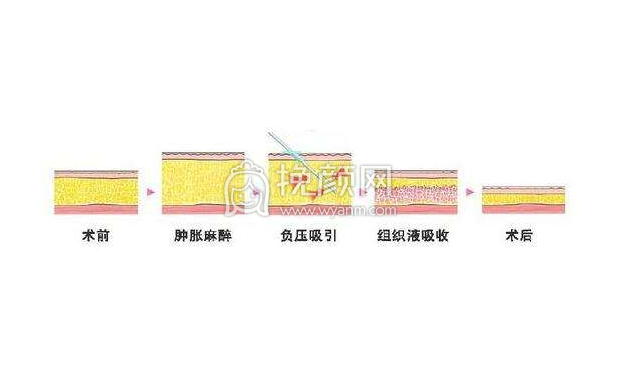 吸脂减肥应注意哪些?