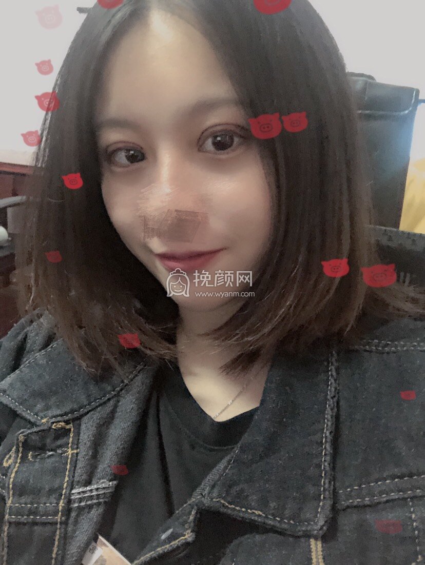 惠城瑞芙臣美容医院刘丹虹医生切开双眼皮案例