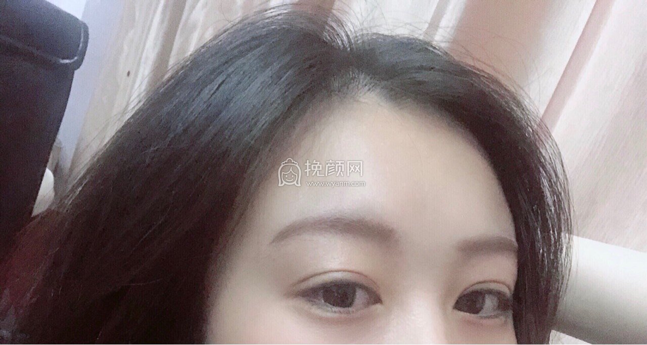 惠城瑞芙臣美容医院刘丹虹医生切开双眼皮案例