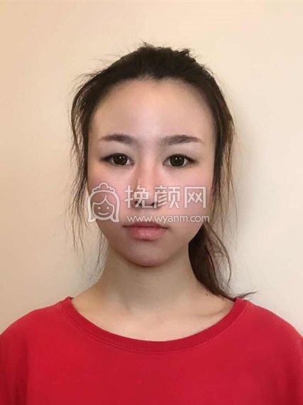 温州和平整形刘照文医生切开双眼皮案例分享!