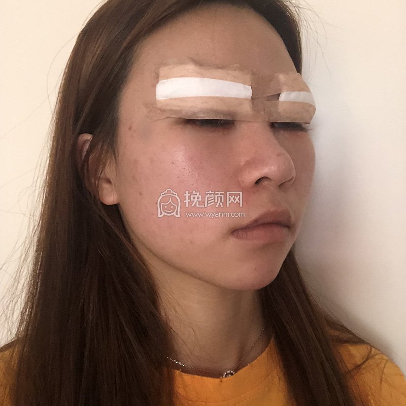 温州和平整形刘照文医生切开双眼皮案例分享!