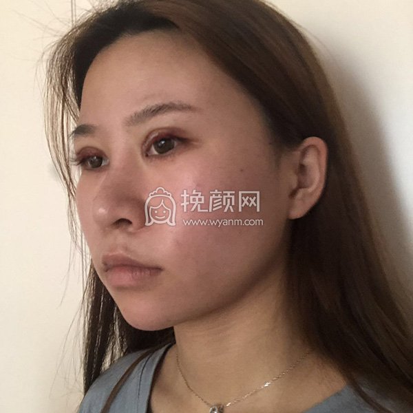 温州和平整形刘照文医生切开双眼皮案例分享!