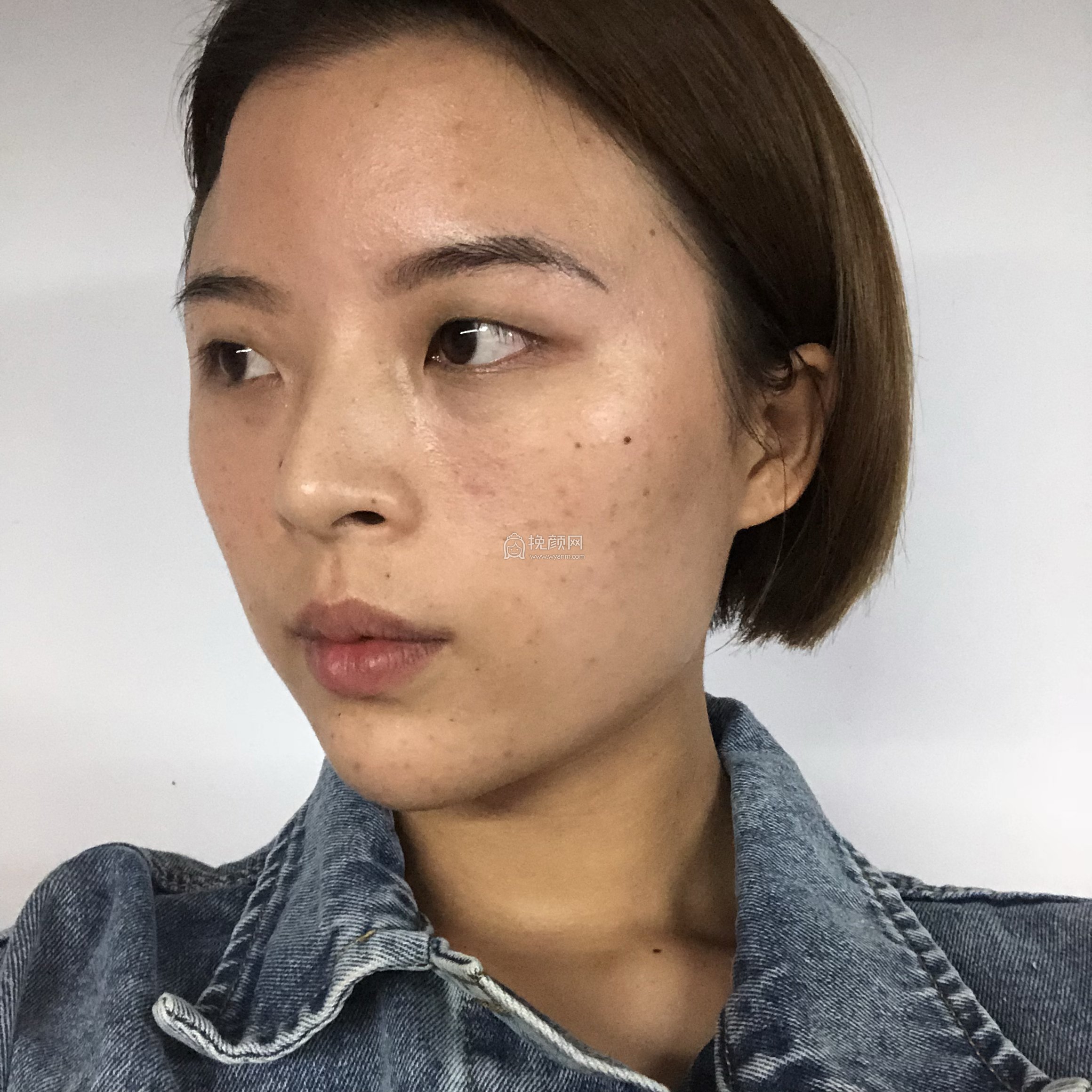 郑州爱美丽整形美容医生崔黎丹切开双眼皮案例