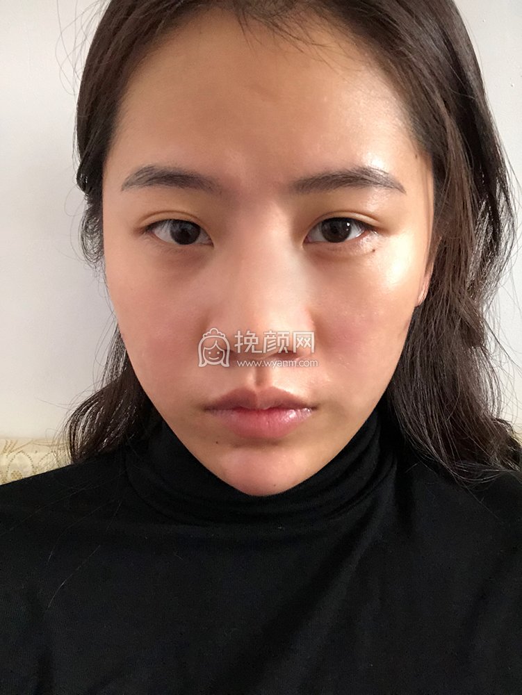 贵阳美贝尔医疗美容医生宋俊辉隆鼻案例分享!