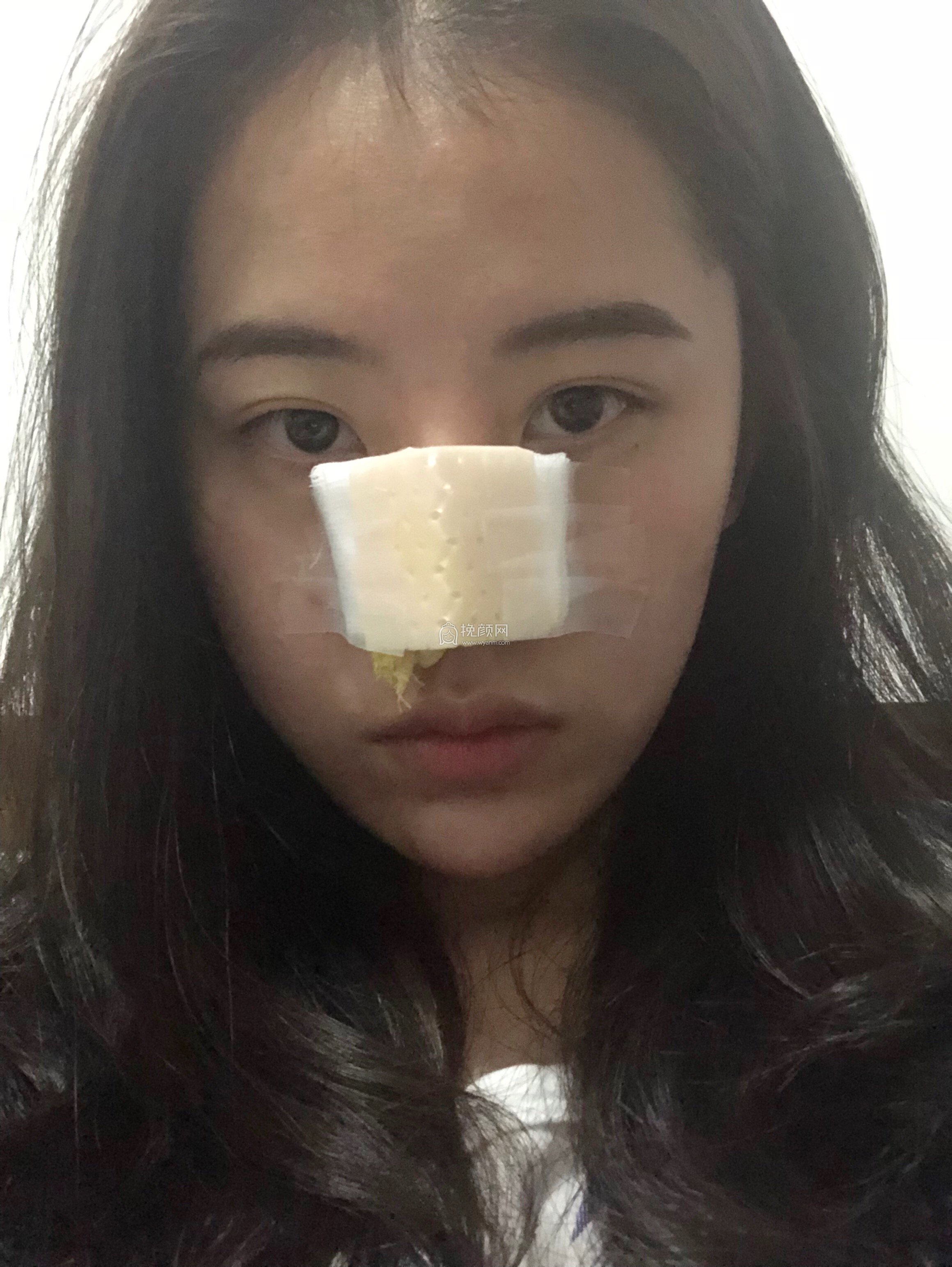 贵阳美贝尔医疗美容医生宋俊辉隆鼻案例分享!