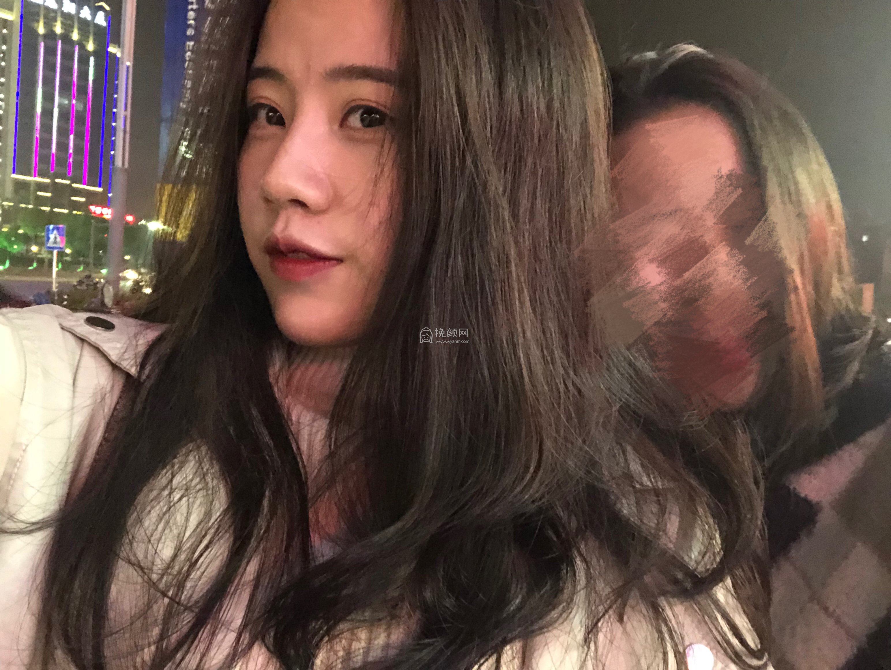 贵阳美贝尔医疗美容医生宋俊辉隆鼻案例分享!