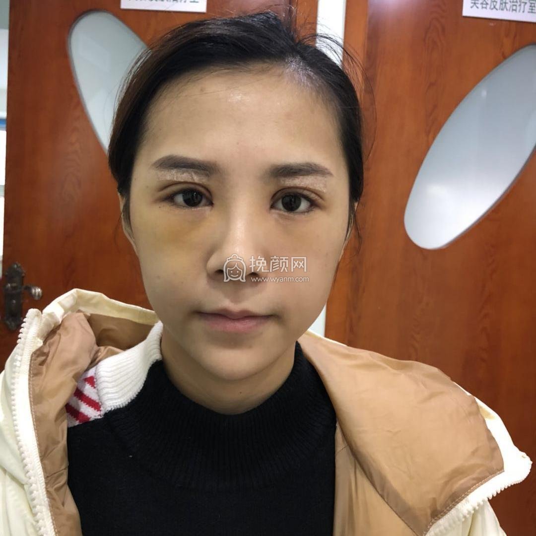 成都美未央医疗美容医院切开双眼皮怎么样?