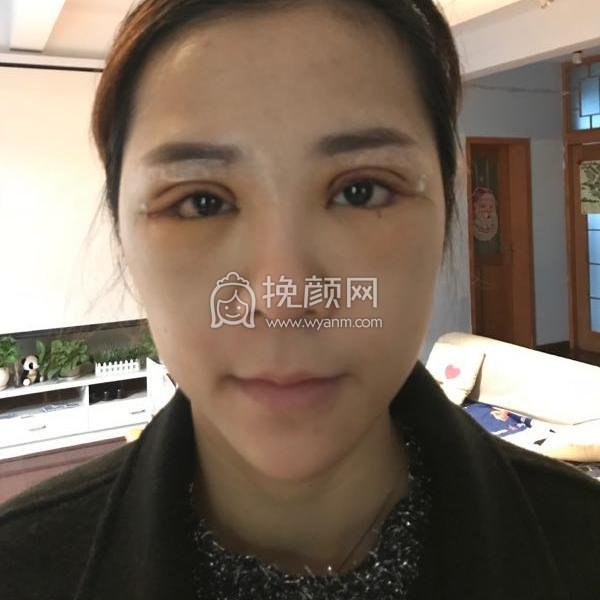 成都美未央医疗美容医院切开双眼皮怎么样?