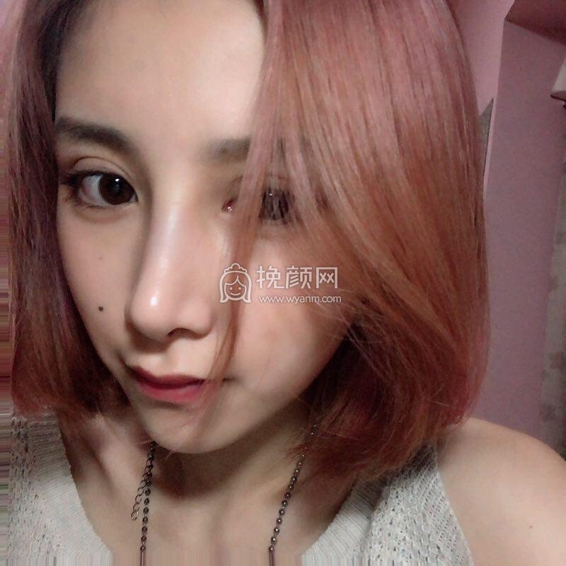 【肋软骨隆鼻】重庆新瑞俪李光强做得怎么样?
