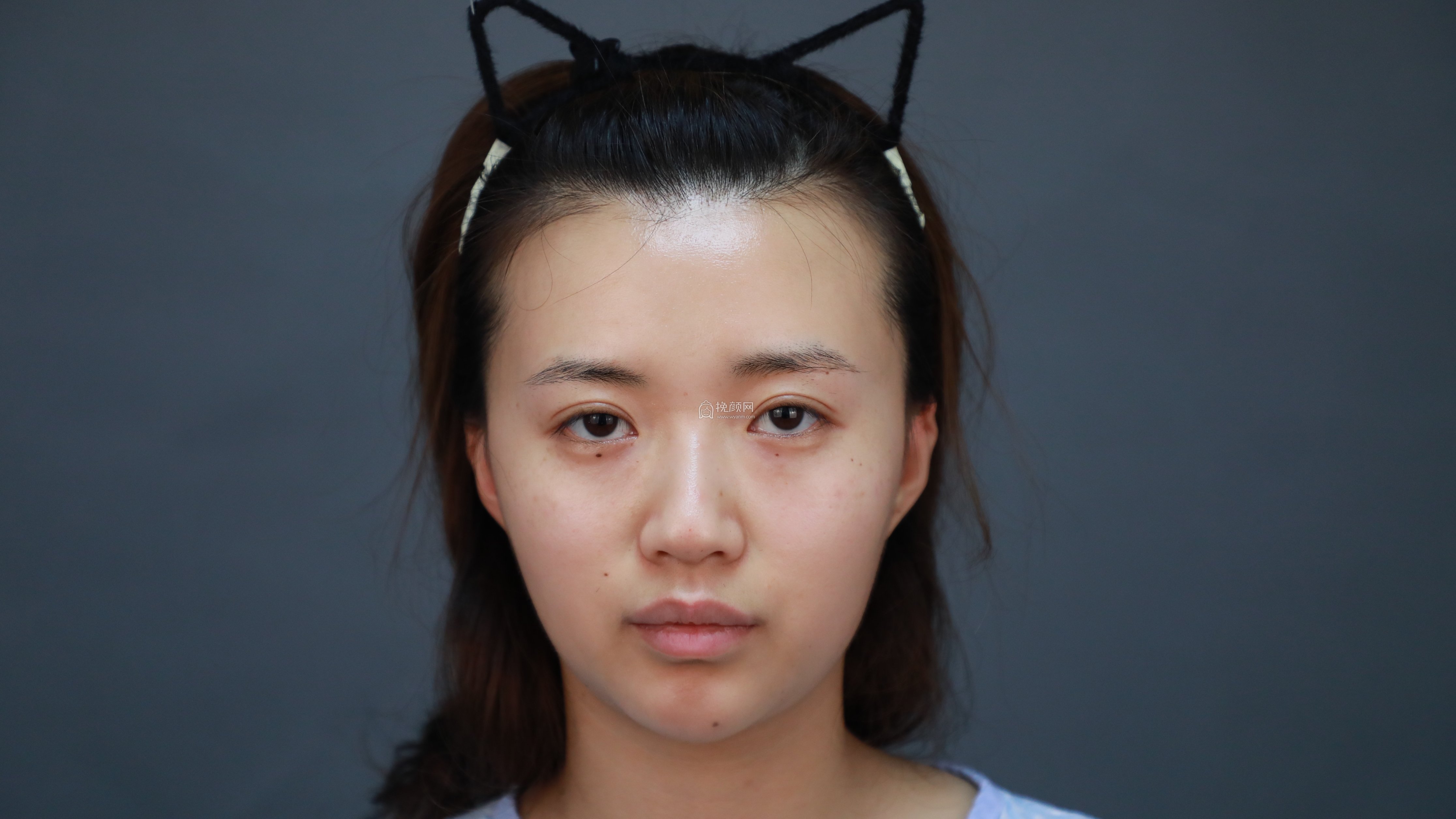 南京美莱赵其中肋软骨隆鼻果怎么样？