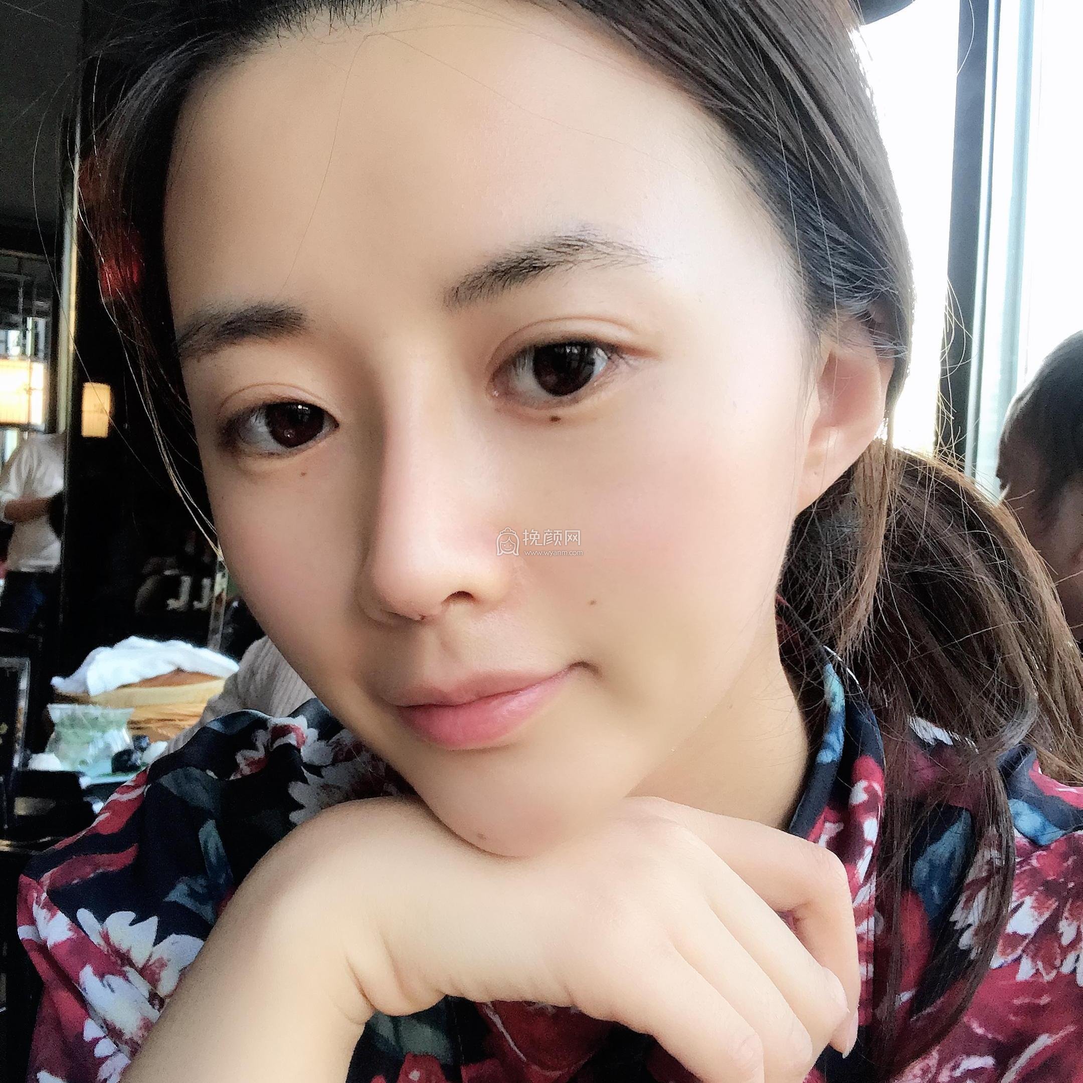 南京美莱赵其中肋软骨隆鼻果怎么样?