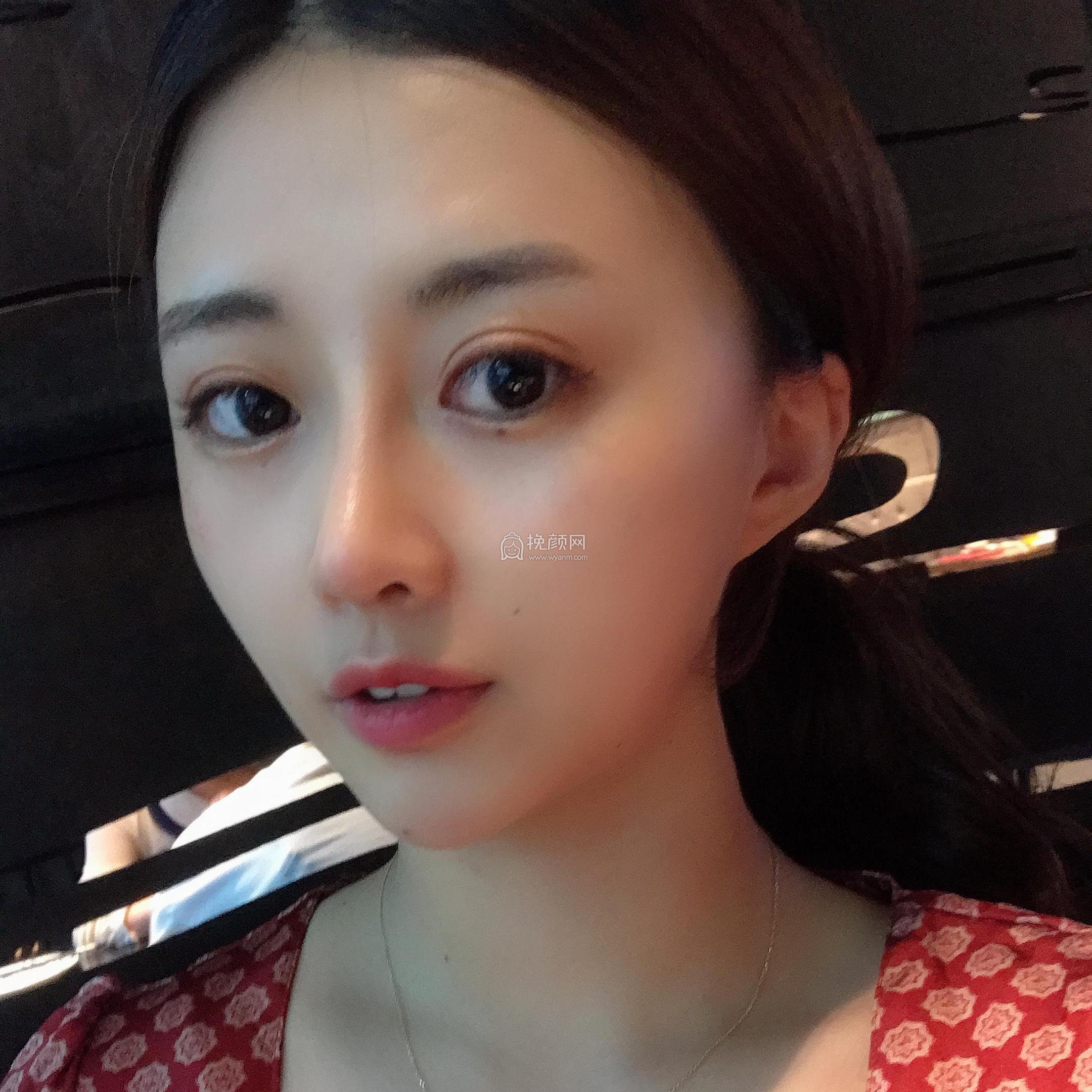南京美莱赵其中肋软骨隆鼻果怎么样?