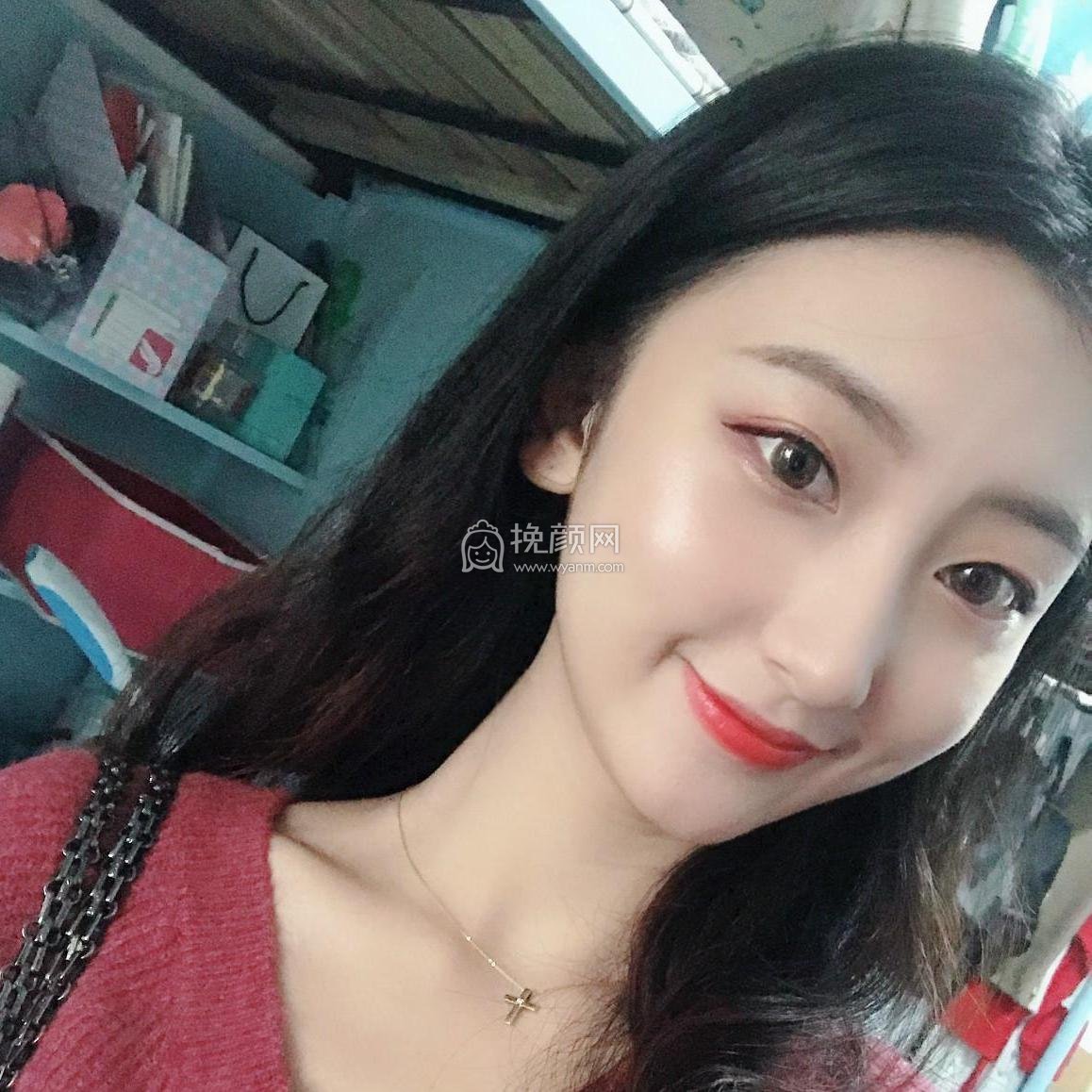 南京美贝尔黄名斗肋软骨隆鼻案例分享!