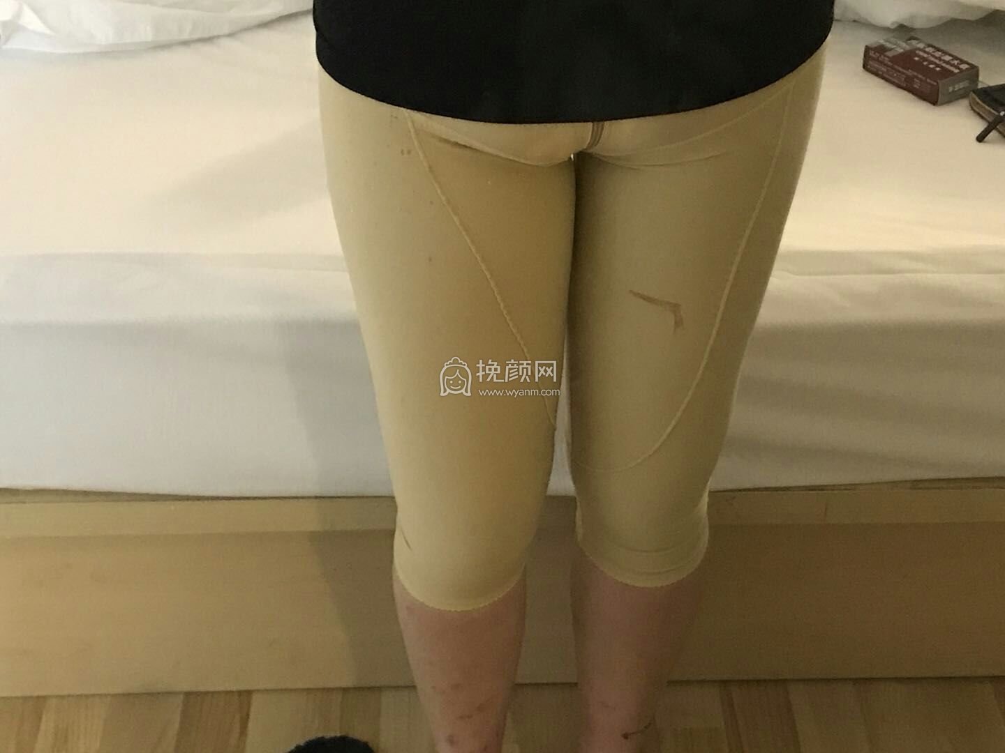 上海爱莫儿孙长辉全身吸脂果怎么样?