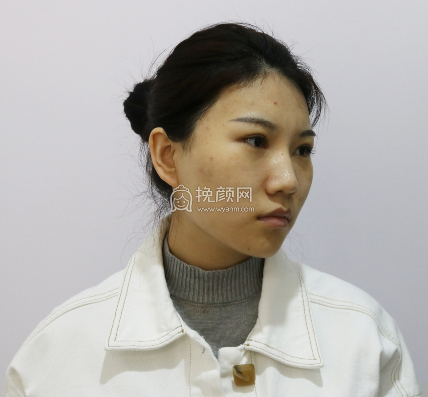 美诗沁世茂刘勇兰自体脂肪面部填充果怎么样