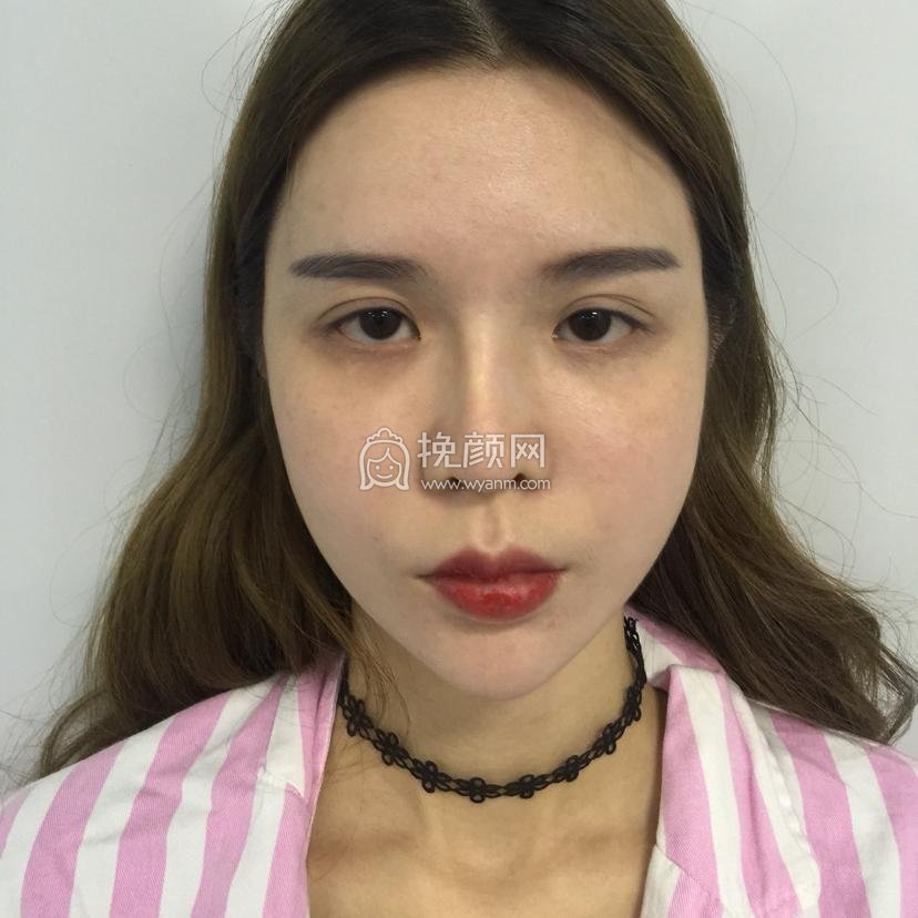 成都美雅娜廖连平隆鼻修复果怎么样?