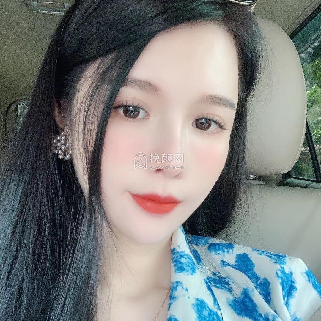 成都美雅娜廖连平隆鼻修复果怎么样?