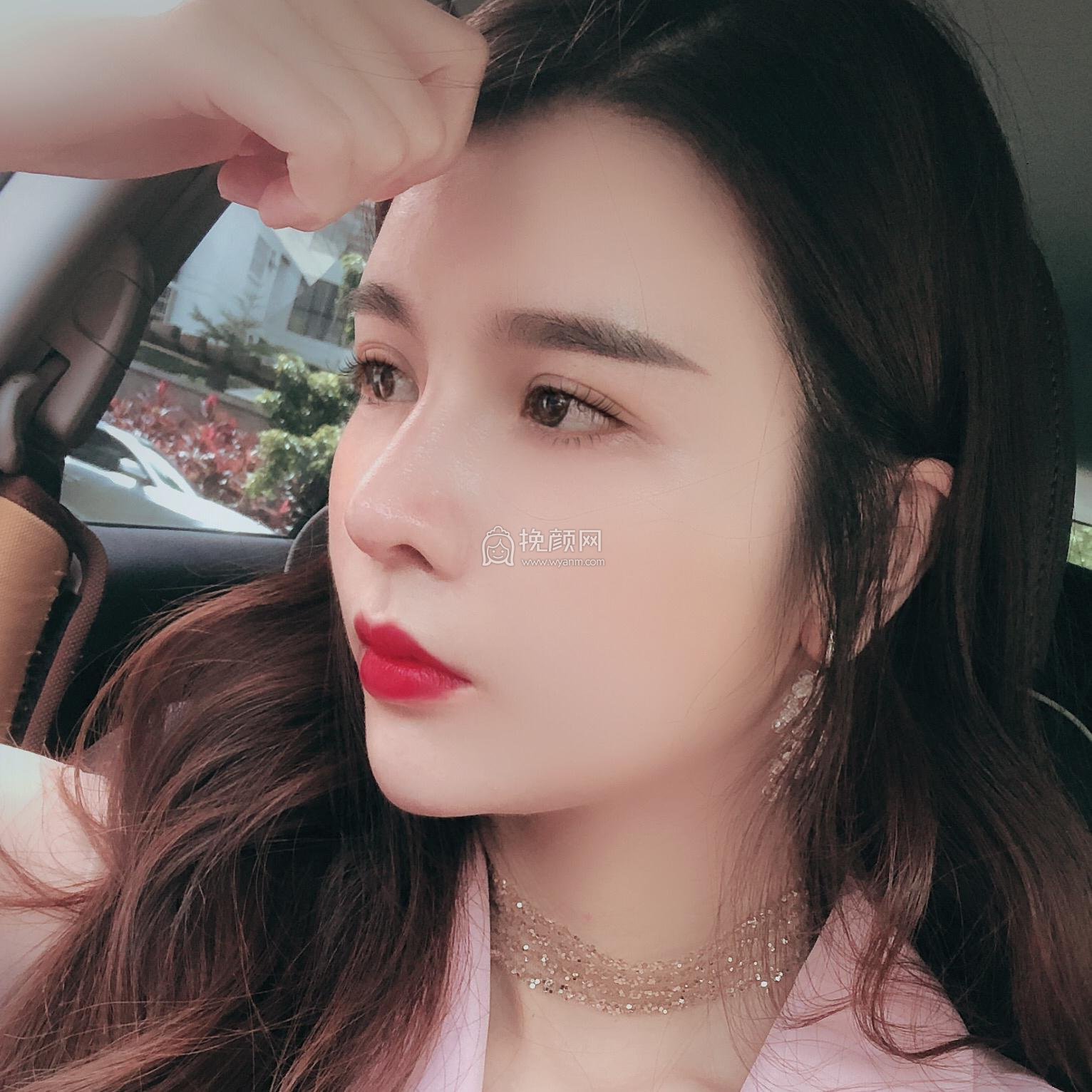 成都美雅娜廖连平隆鼻修复果怎么样?