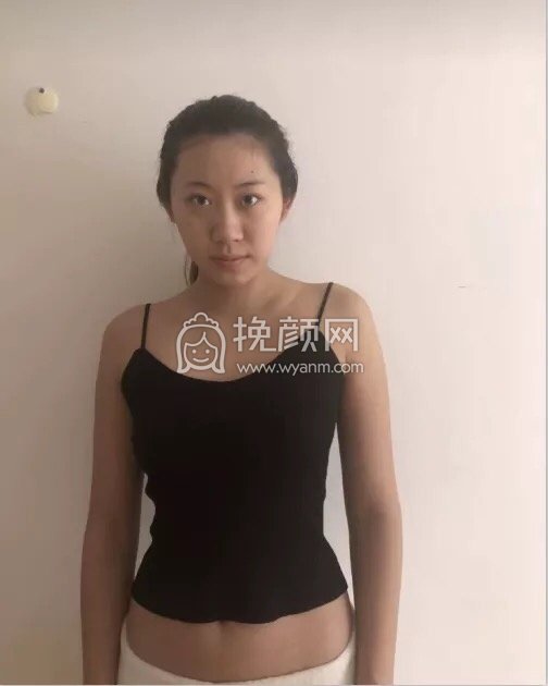 北京美莱董岩岩假体隆胸案例分享!