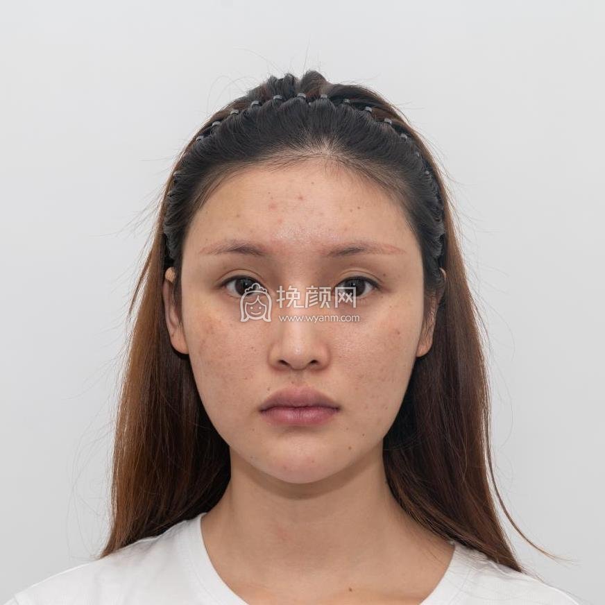 重庆美莱郑楠做的面部吸脂果怎么样?