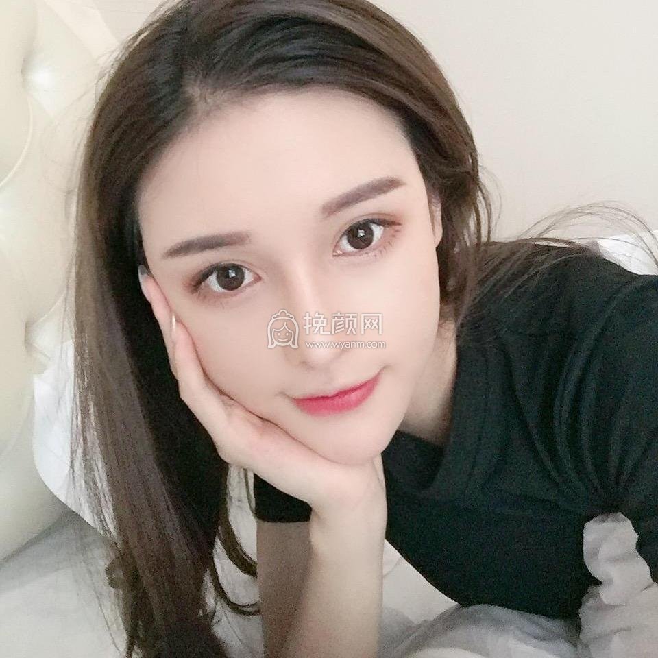 重庆美莱郑楠做的面部吸脂果怎么样?