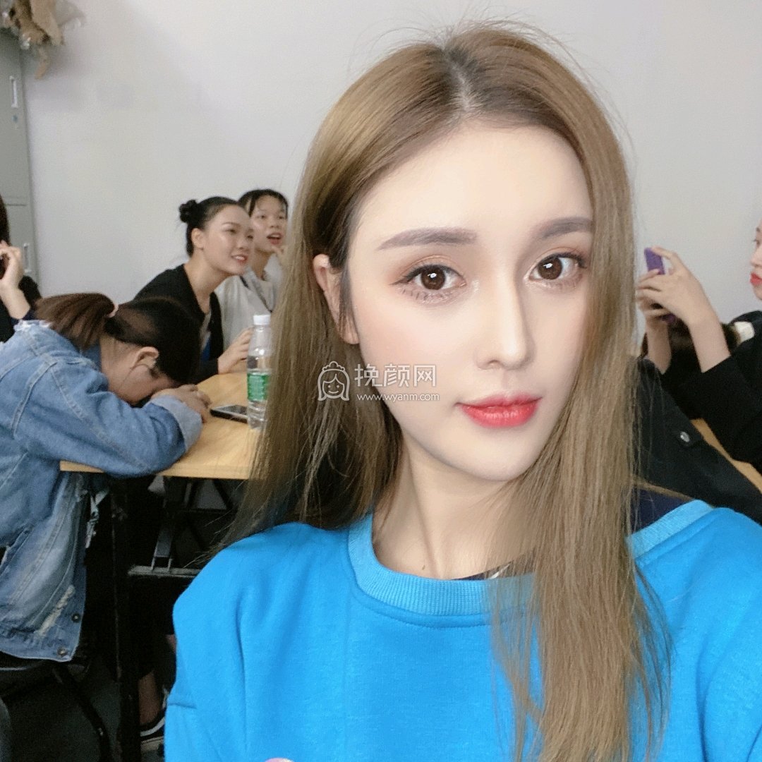 重庆美莱郑楠做的面部吸脂果怎么样?