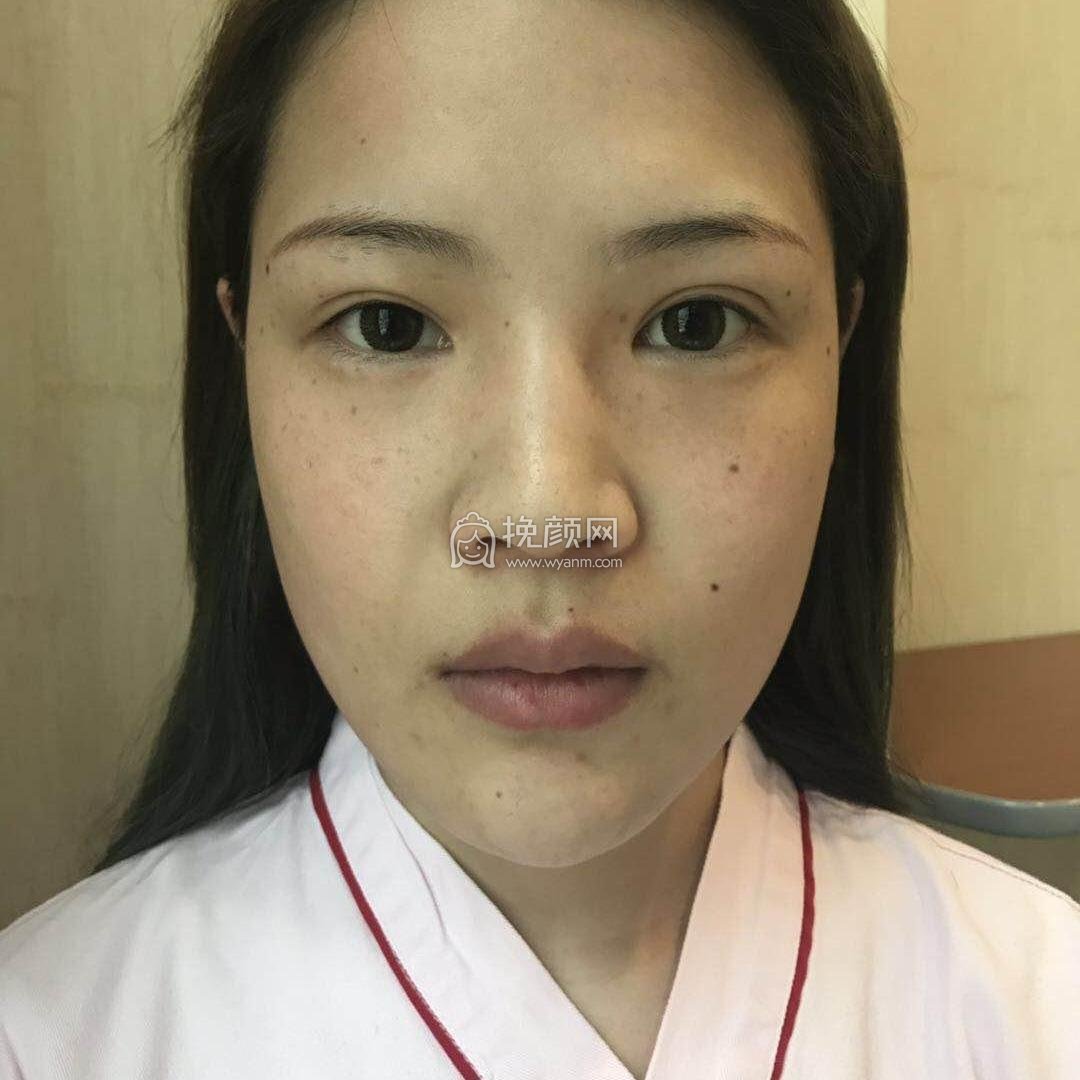 上海伯思立李茂群肋软骨隆鼻果好不好?