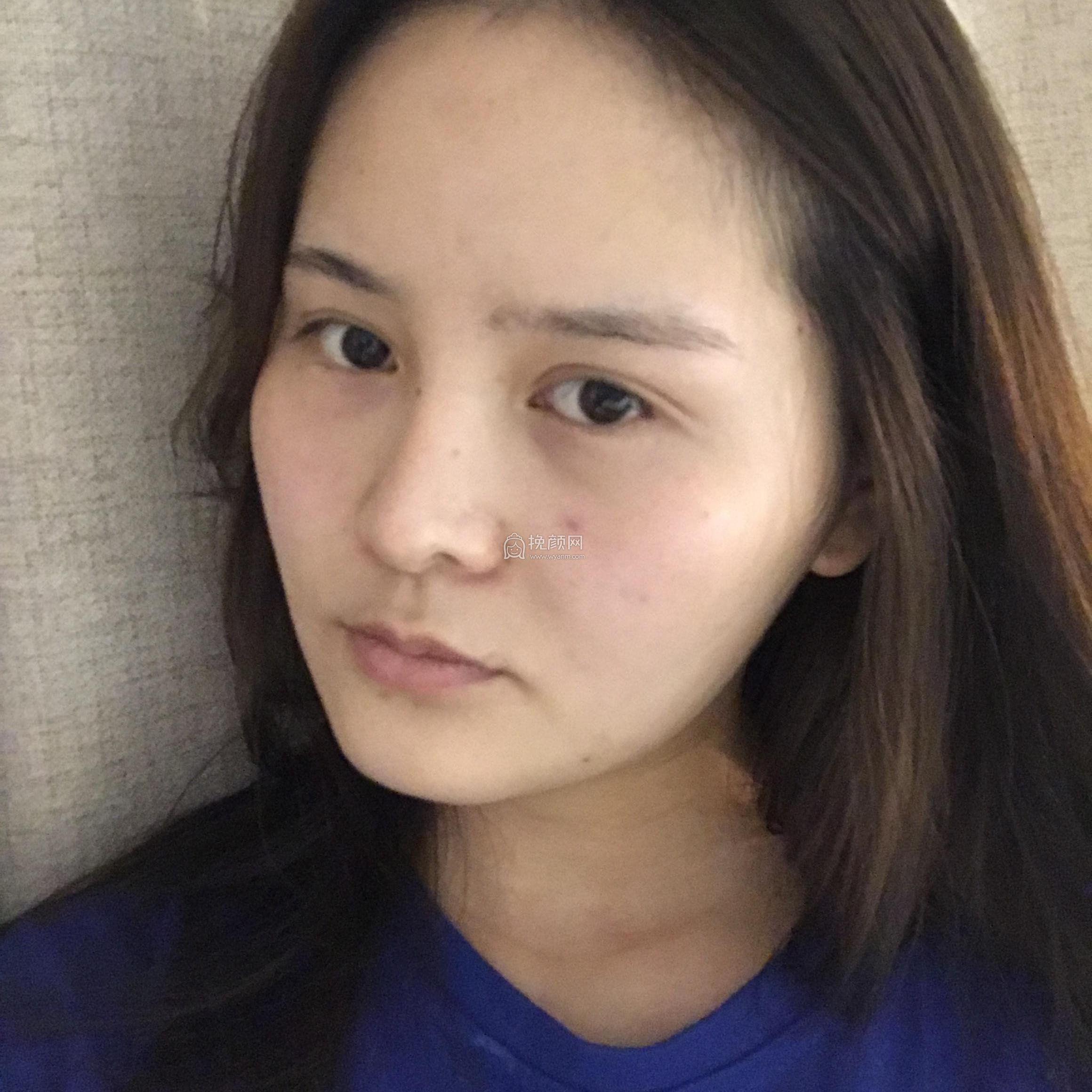 成都天使之翼尤军做自体脂肪面部填充怎么样?