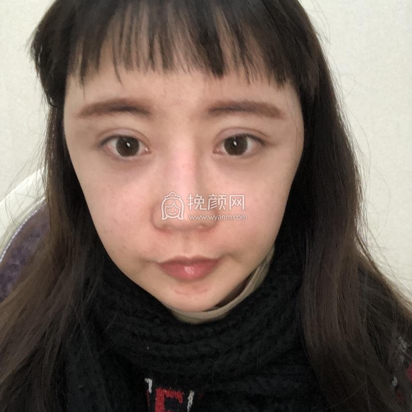 成都蜀尚蓉雅朱永光光纤溶脂瘦脸果怎么样?