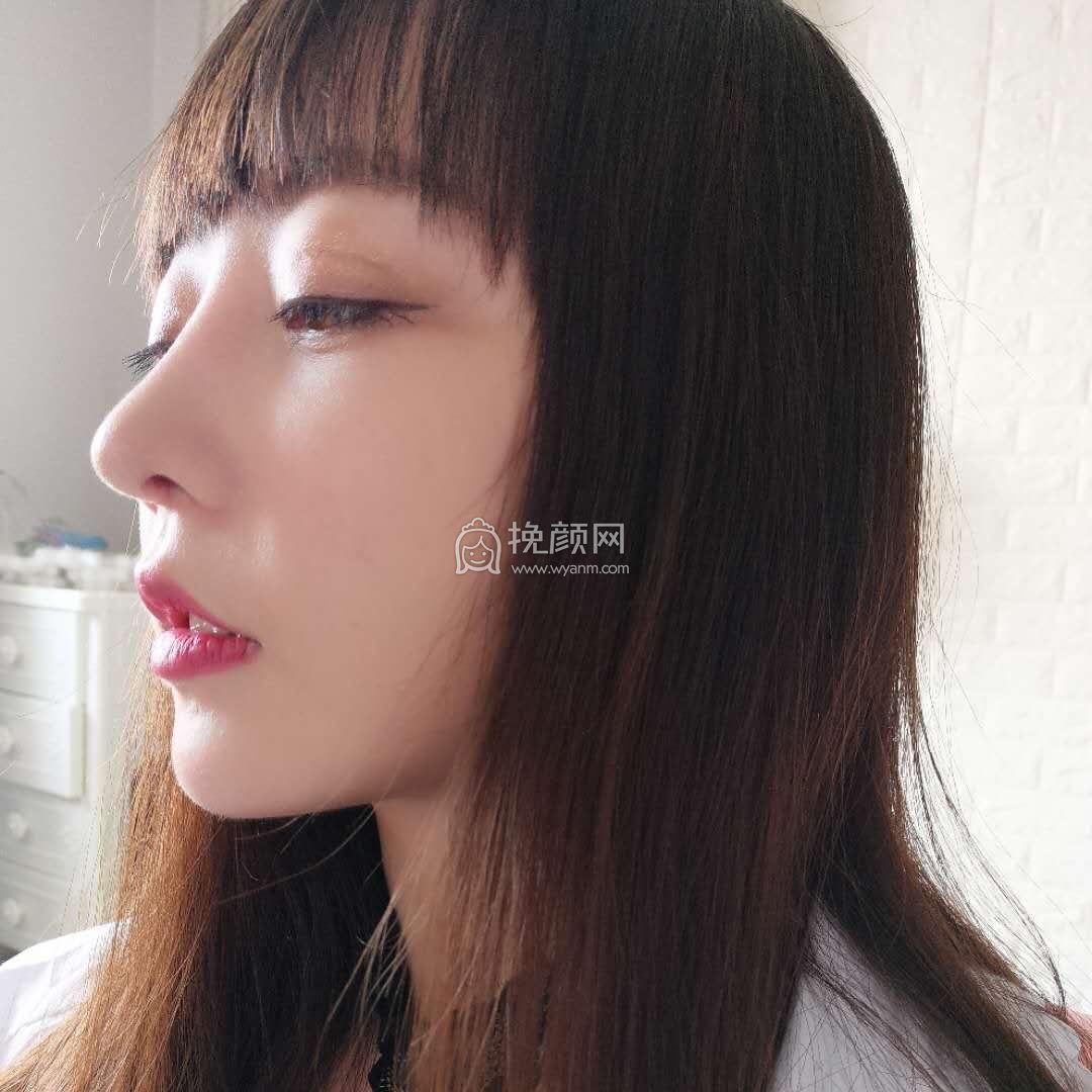 成都蜀尚蓉雅朱永光光纤溶脂瘦脸果怎么样?