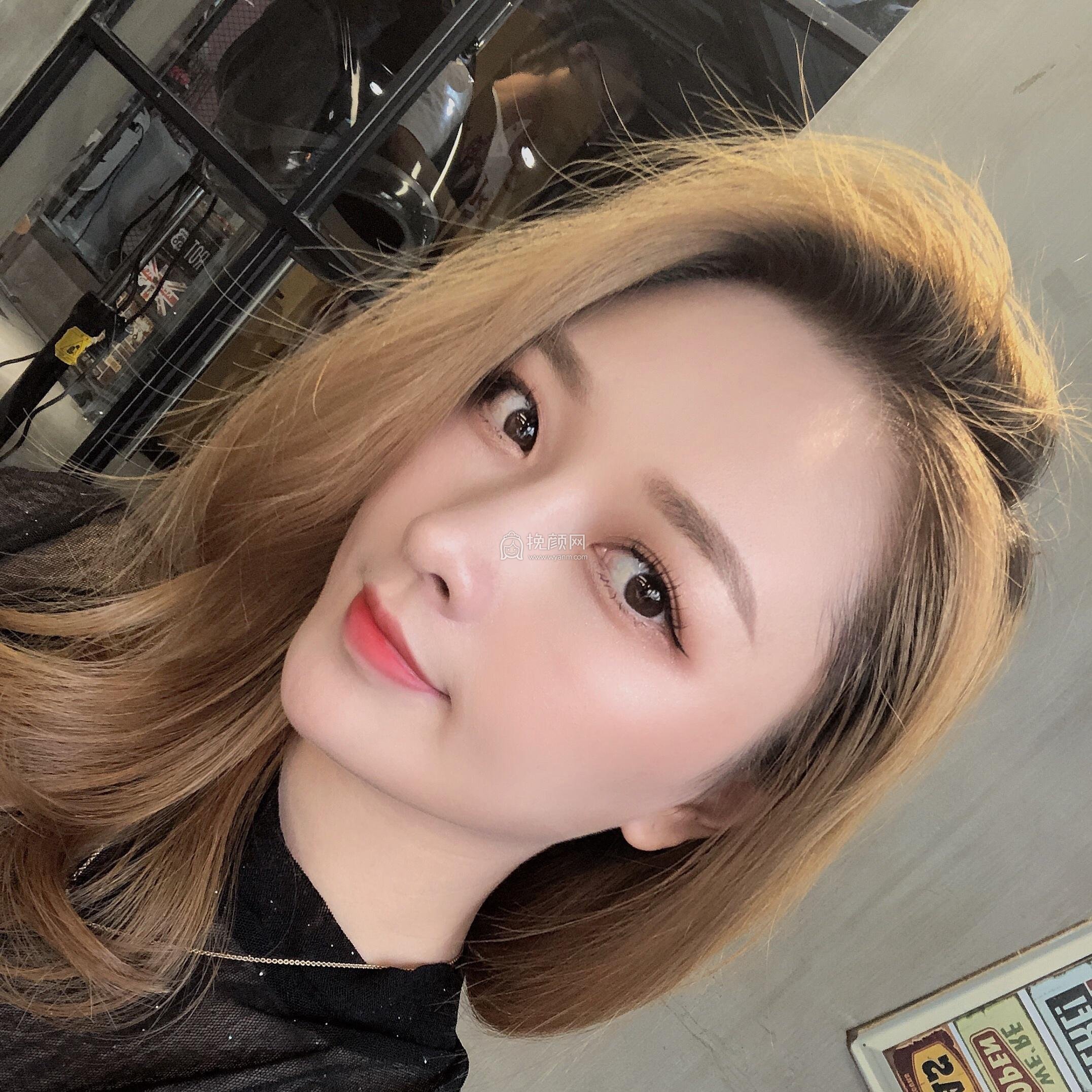 上海百达丽顾清半肋/全肋软骨隆鼻案例分享!
