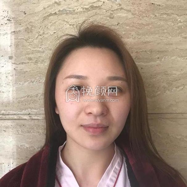 上海百达丽顾清半肋/全肋软骨隆鼻案例分享!
