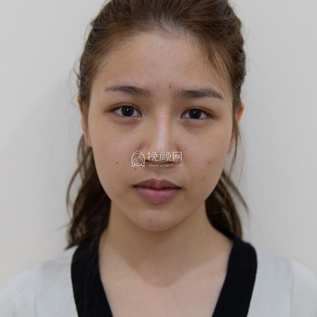广州美莱罗延平鼻修复做得好不好?