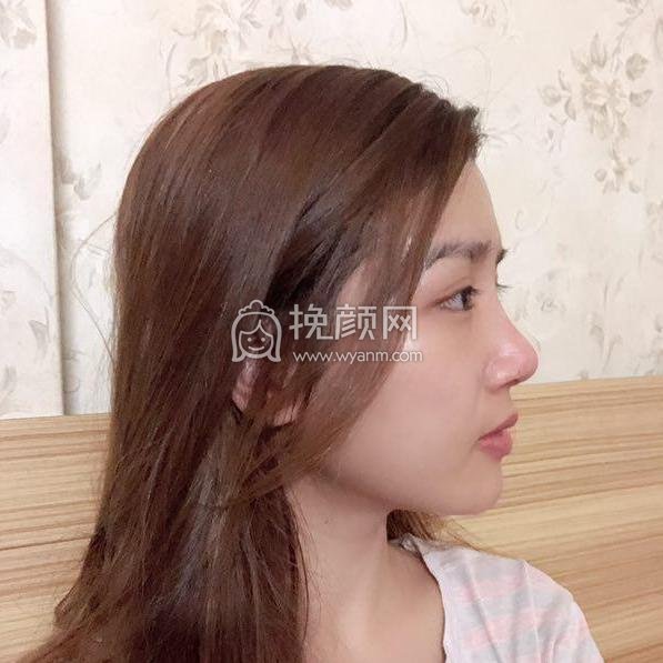 广州美莱罗延平鼻修复做得好不好?