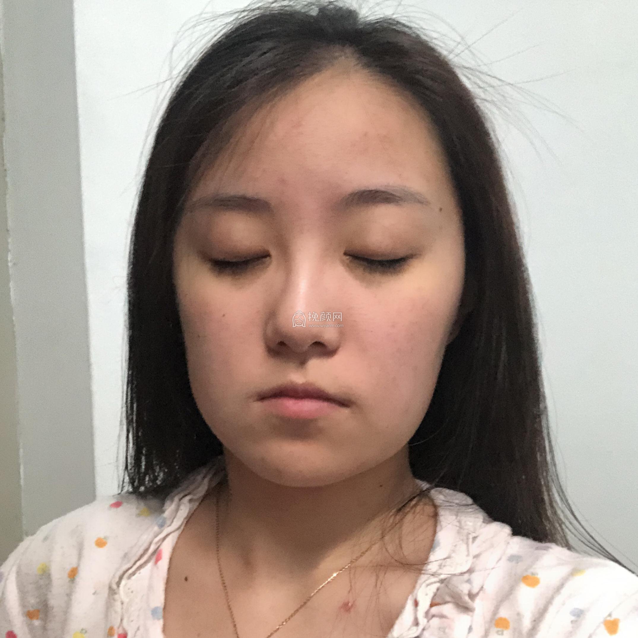 重庆时光陈小平下颌角整形案例!