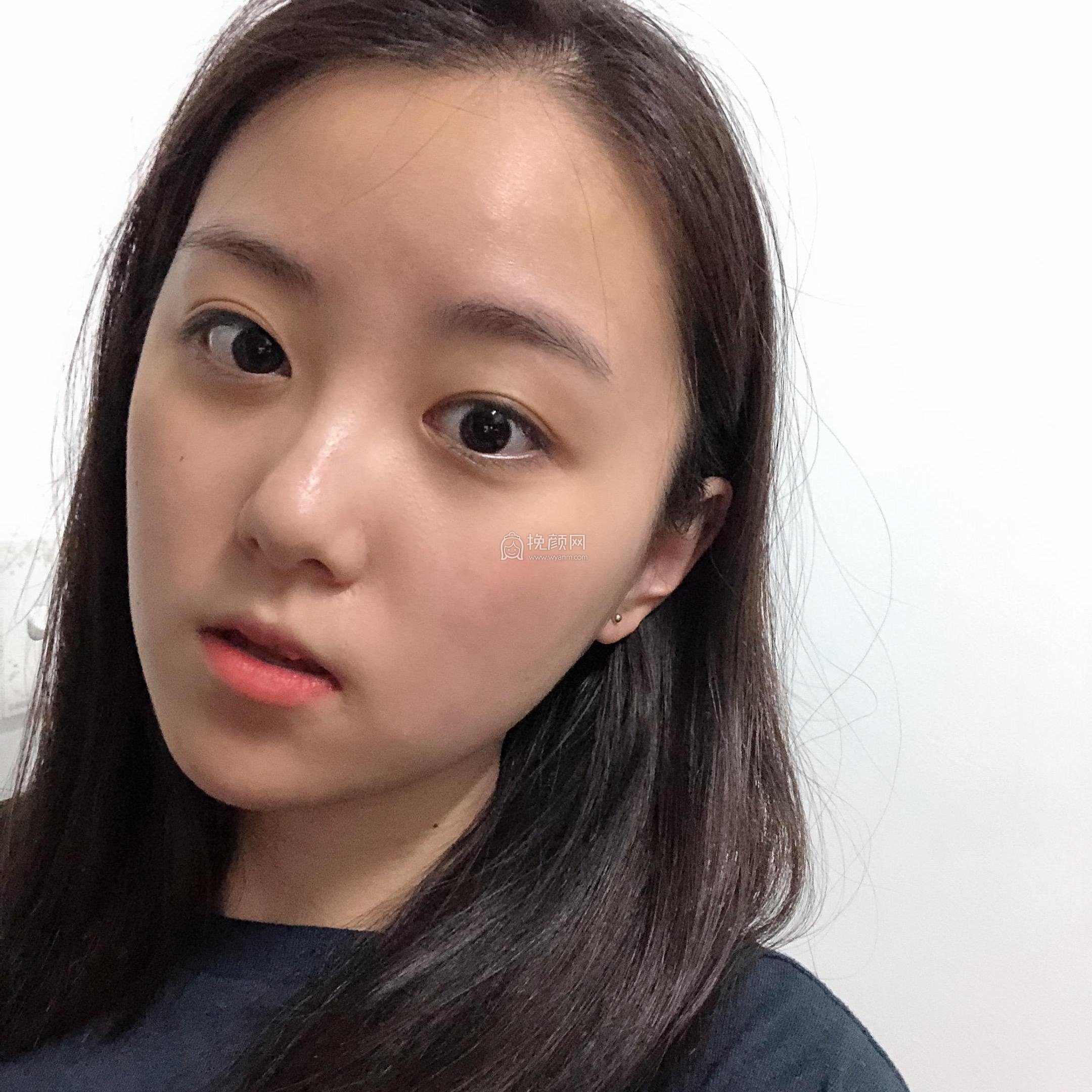 重庆时光陈小平下颌角整形案例!