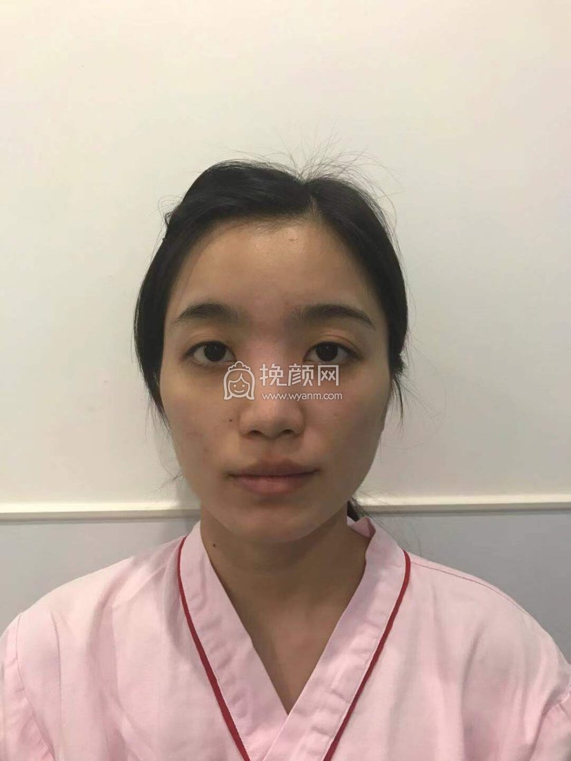 上海伯思立王艳肋软骨隆鼻果怎么样?
