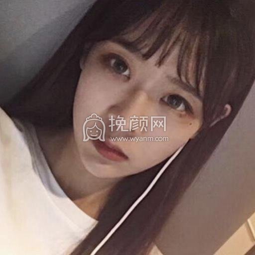 北京华悦府朱燕鼻部手术案例!