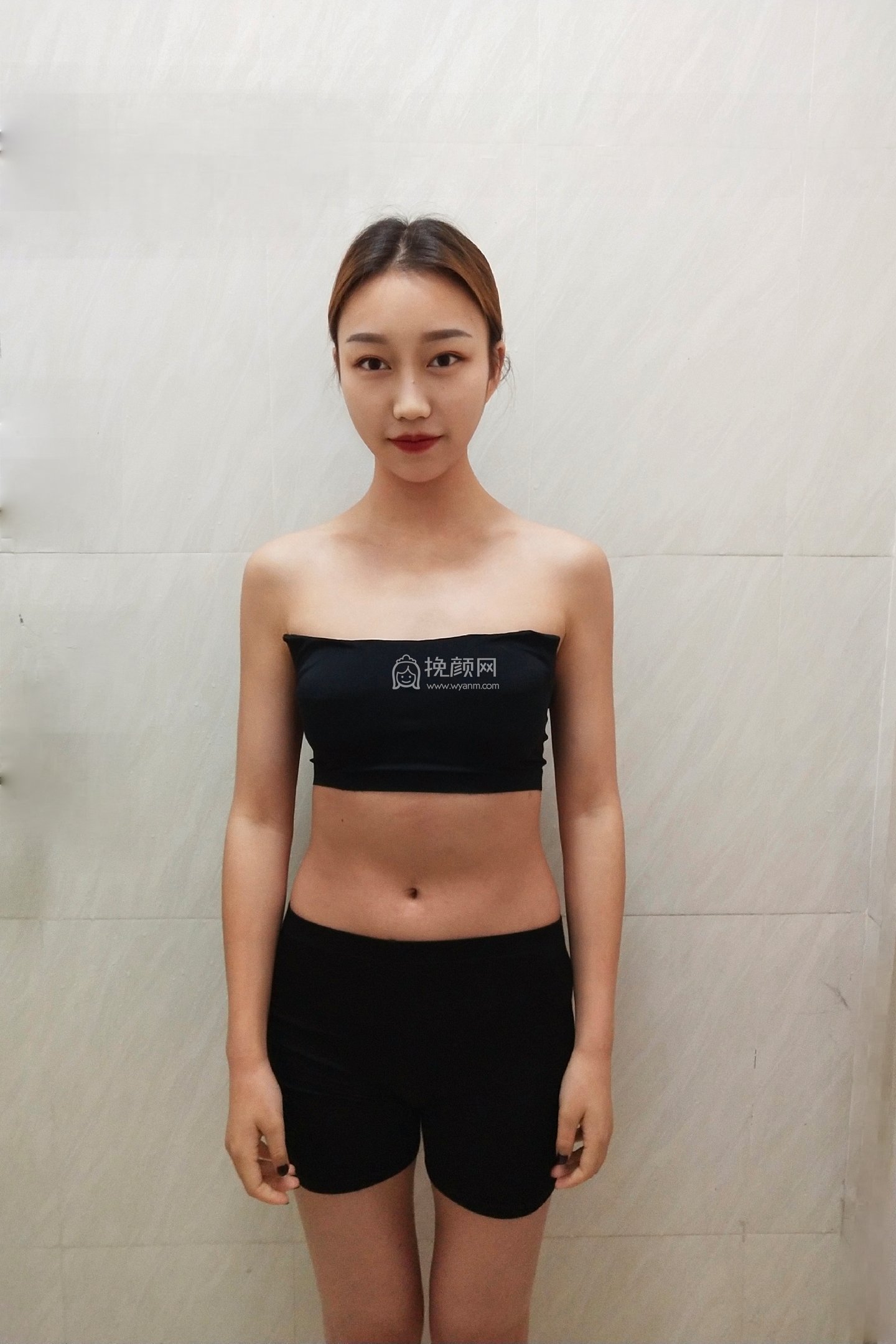 重庆美莱吴继东假体隆胸果如何?