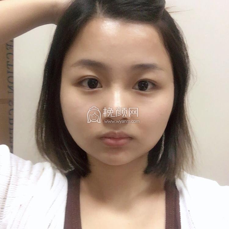 上海爱莫儿尹剑面部吸脂案例!