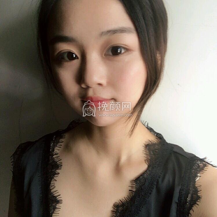 上海爱莫儿尹剑面部吸脂案例!