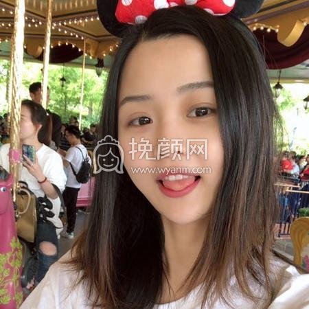 上海爱莫儿尹剑面部吸脂案例!