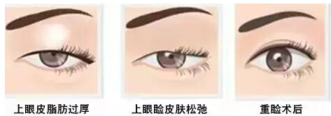 挽颜网为您分析为什么要做双眼皮手术?