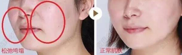 埋线提升提拉美容手术是怎么做的,果怎么样?