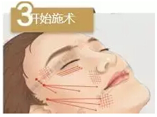 埋线提升提升术调节手术过程是怎样的呢?