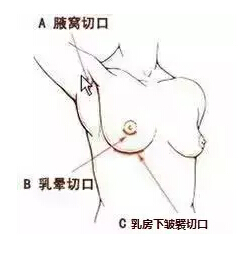 假体隆胸到底假不假?