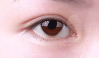 不要只顾好看!双眼皮术前这些问题你需要了解