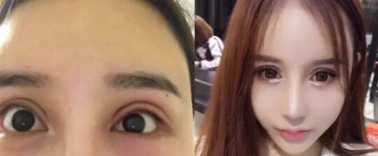 双眼皮割丑了到底怎么救?
