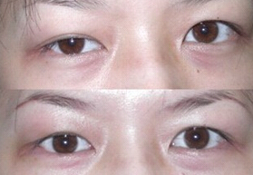 一只眼睛眼睑下垂了该怎么办?
